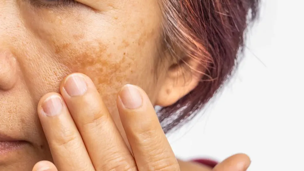 Prevent Pigmentation