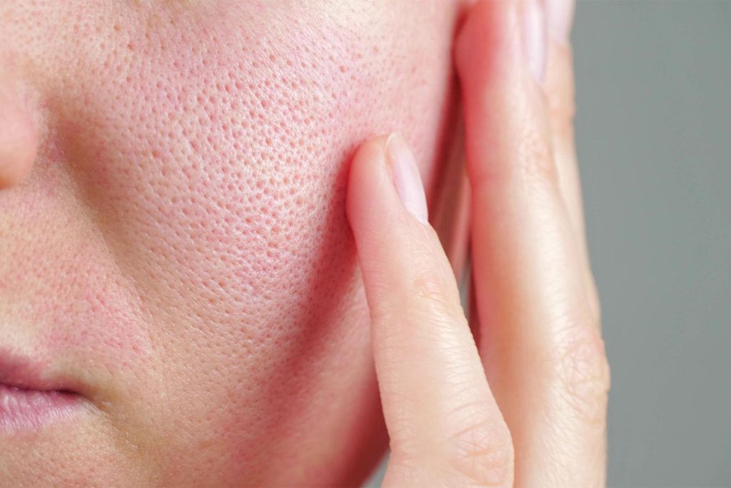 How To Unclog Your Pores Skin Care Tips Miami Md 