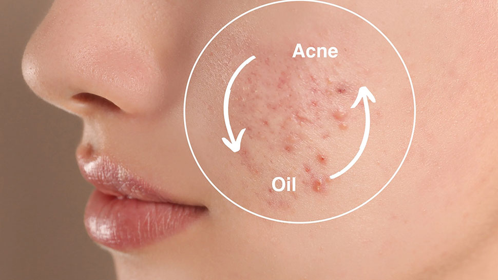 Acne Prone