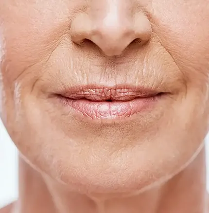 Mouth Wrinkles