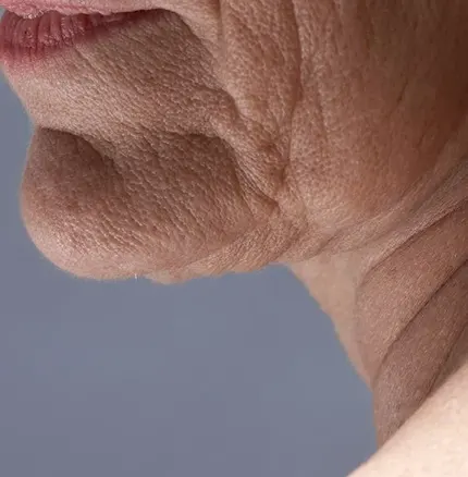 Crepey Skin